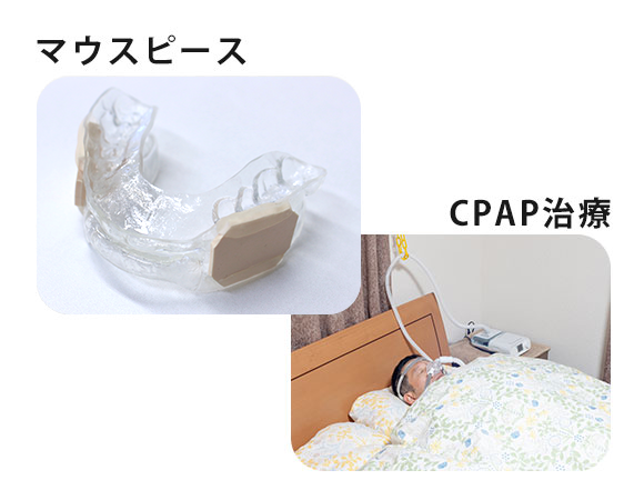 マウスピース・CPAP治療